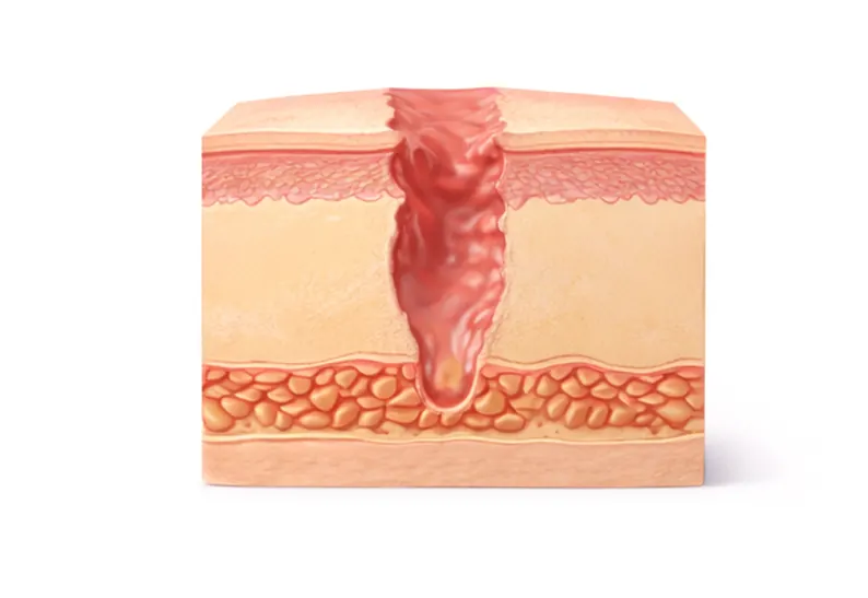 흉터 조직 정리