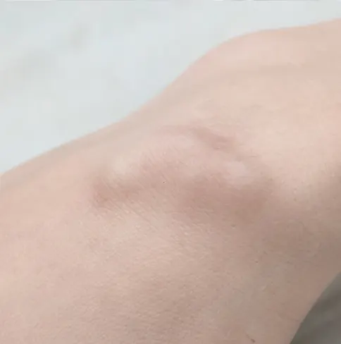결절종 관절 종양