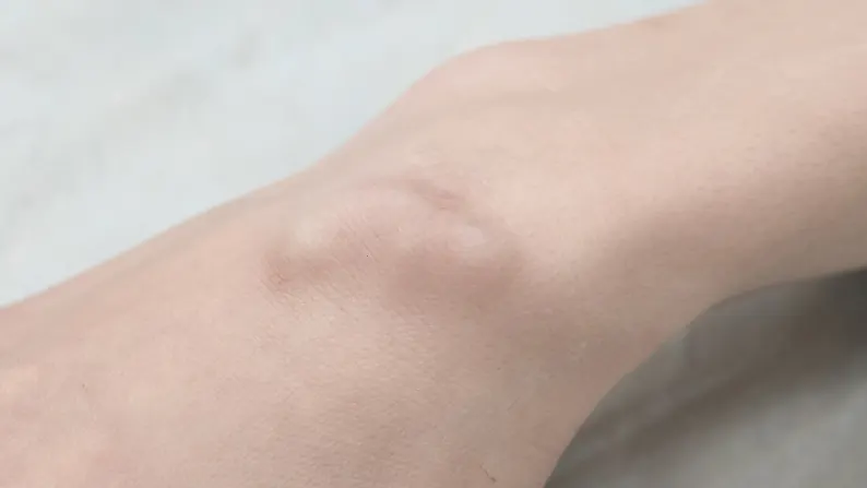 피부양성종양 경험 많은 의료진