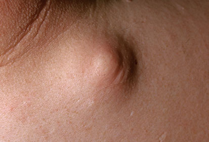 피지낭종 (Epidermal Cyst)