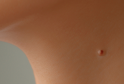 쥐젖 (Skin Tag)